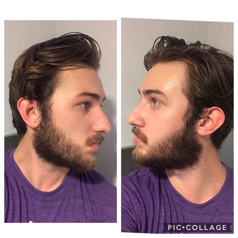 20m My Beard Is Considerably Thicker Beneath My Jaw Line Than Above