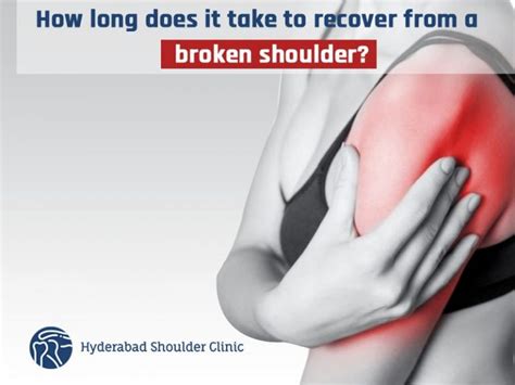 Maybe you would like to learn more about one of these? How Long Does It Take To Recover From A Shoulder Fracture?