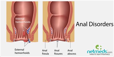 Anal Fissure Signs Telegraph