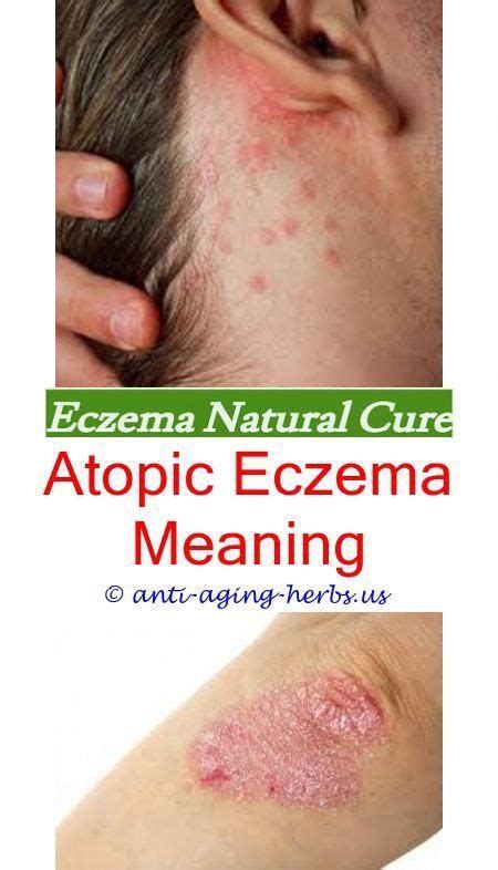 Seborrhoeic Eczema Eardermatitis Herpetiformis Vs Dyshidrotic Eczema