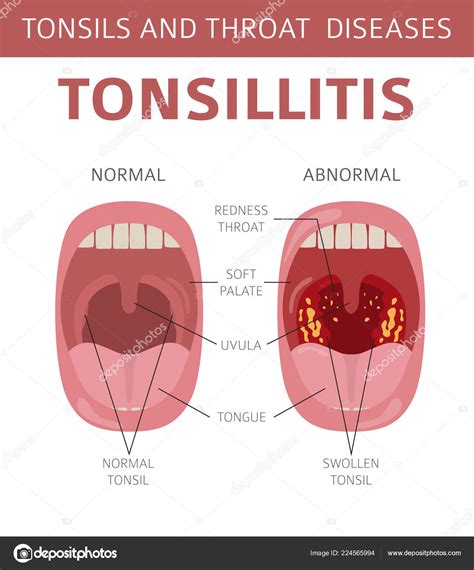 Tonsils Throat Diseases Tonsillitis Symptoms Treatment Icon Set Medical
