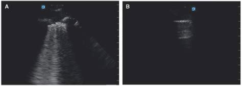 Differentiating Pulmonary Edema Pneumonia Copdasthma Bronchiolitis