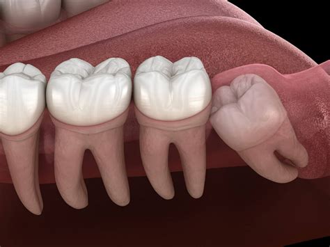 Wisdom Teeth Removal Finger Lakes Dental New York