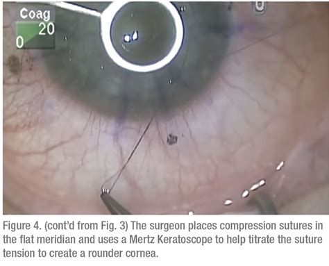 How To Handle Astigmatism After Pk