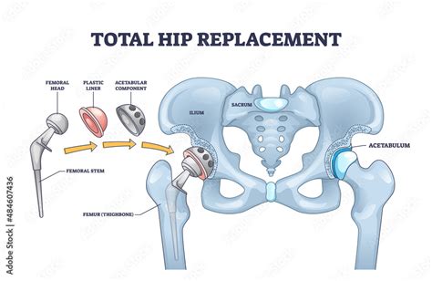 Vecteur Stock Total Hip Replacement Surgery With Anatomical Acetabular