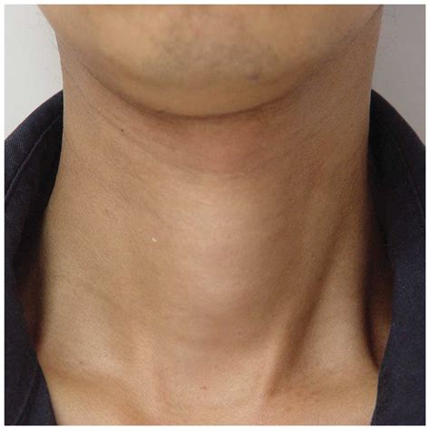 Twothreesixonenineeightseven Inflamed Thyroid In Neck