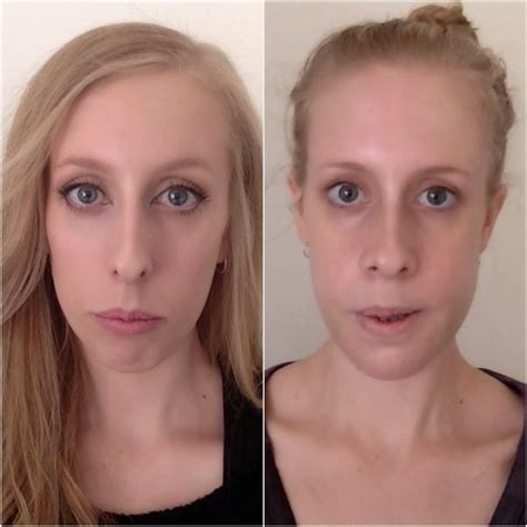 Double Jaw Surgery Journey 3 Weeks Post