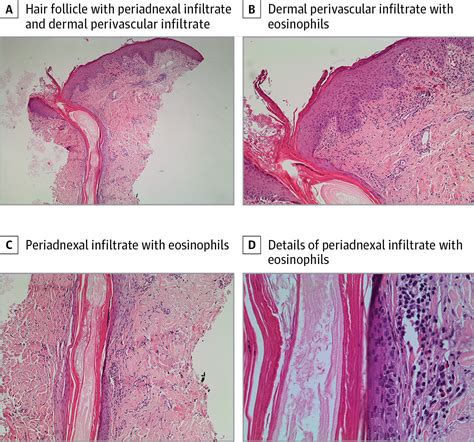 Eosinophilic Polymorphic And Pruritic Eruption Associated With