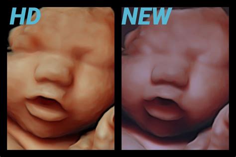 NEW - Real Glimpse - First Glimpse 3D / 4D Ultrasound