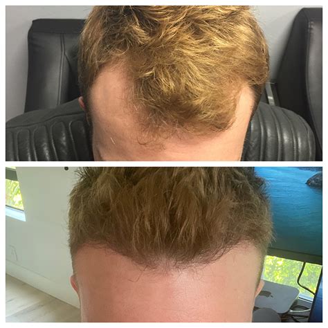 Why choose a robotic hair transplant? ARTAS Hair Restoration - San Jose - Best Hair Restoration ...