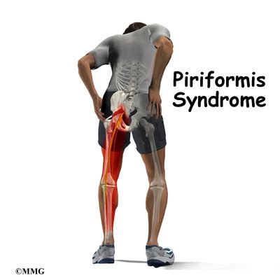 Piriformis Syndrome Orthopedic Surgery Algonquin Il Barrington Il