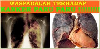 Sementara itu kuman tbc akan merusak jaringan paru sehingga akan mati dan menimbulkan bekas rongga seperti lubang. SOLUSI HERBAL 10 PENYAKIT KRONIS DI INDONESIA : KANKER ...