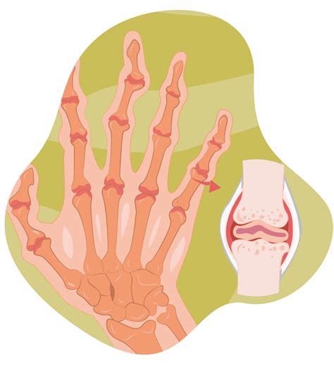 Artritis Reumatoide Síntomas tratamiento y diagnóstico IMSKE
