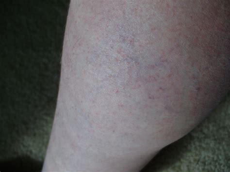 Are Tiny Red Dots On My Legs Due To Warfarin Valvereplacement