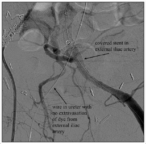 Iliac Arteriogram After Deployment Of An External Iliac Artery Stent
