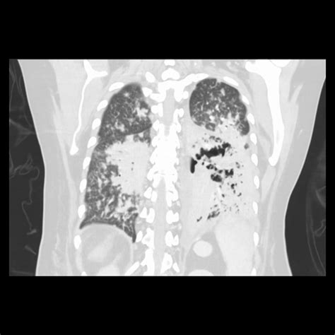 Cureus An Unusual Case Of Blastomycosis And Severe Lung Necrosis In A Hmong Woman With
