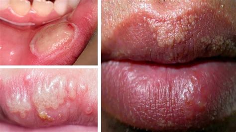 How To Get Rid Of Fordyce Spots On Lips Overnight 6 Home Remedies For
