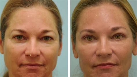 One Week After Upper Blepharoplasty Video And Photos Youtube