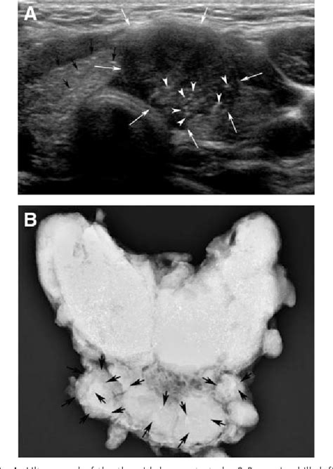 Figure 1 From Diffuse Sclerosing Variant Of Papillary Carcinoma Of The