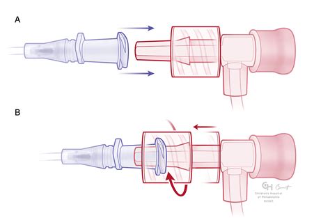 Managing Luer Connections Anesthesia Patient Safety Foundation