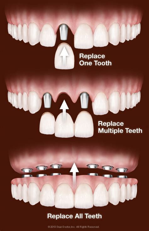 Faq About Dental Implants Rogers Dental Center Rogers Mn