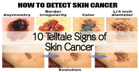 10 Warning Signs Of Skin Cancer