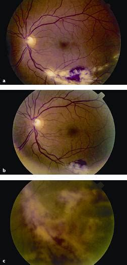 Funduscopic Examination For Cme Retinitis American Academy Of