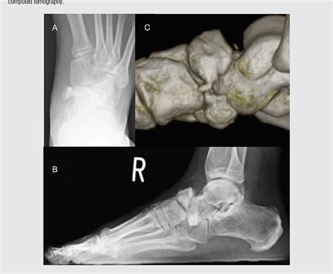 Figure 2 From Isolated Talonavicular Arthrodesis For Traumatic