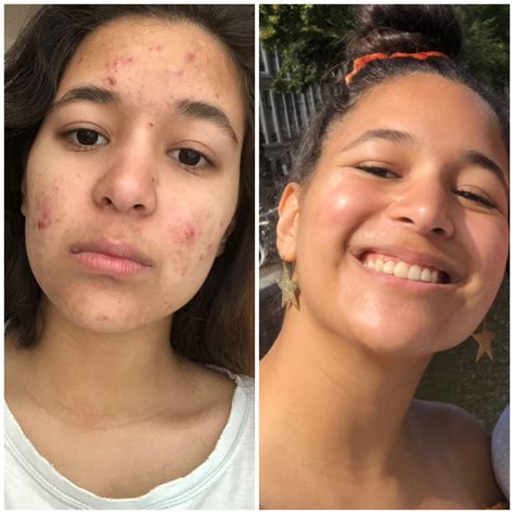 Before And After Accutane R Acne