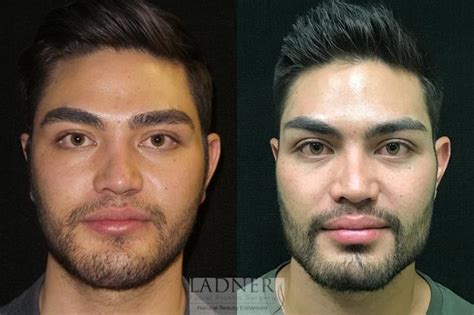 Facial Plastic Surgery For Men Before And After Pictures Case 66