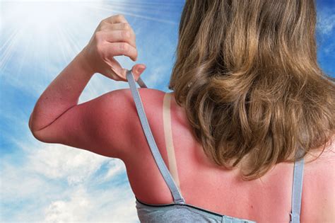 Sunburn Concept Young Woman With Red Sunburned Skin On Her Back Stock