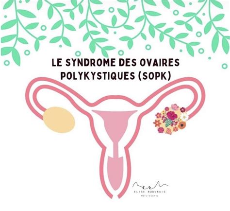 Le Syndrome Des Ovaires Polykystiques La Tresse