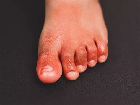 Covid Toes What Is Covid Toes Causes Symptoms And All You Need To Know