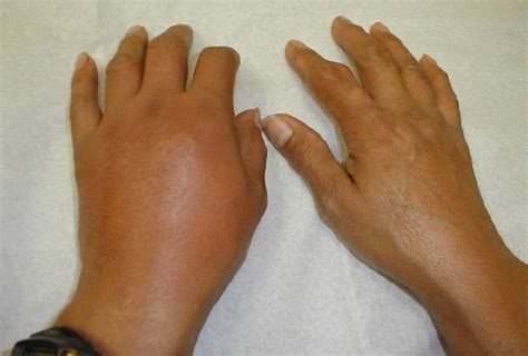 Gout Symptoms And Diagnosis Gout Pain Relief