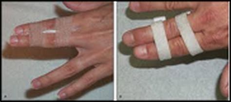 Finger Sprain Roland Jeffery Physiotherapy
