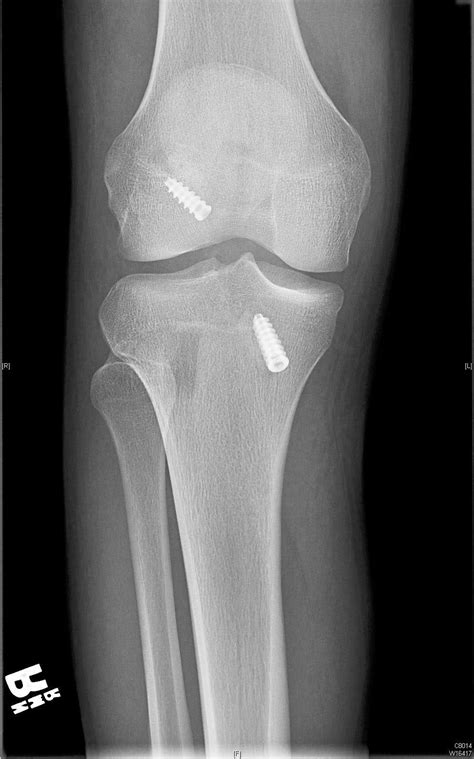 Knee X Ray After Acl Surgery Corben Hanson
