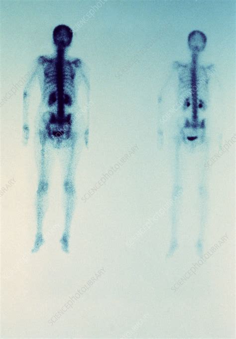 Gamma Scan Of Bone Cancer In Spine And Chest Stock Image M1340025