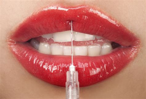 Lip Enhancement Collagen Lip Injection