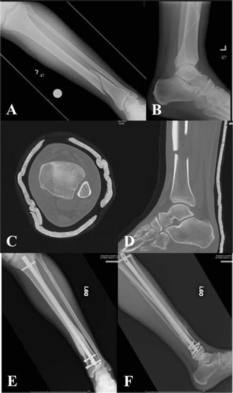 Left Distal Third Spiral Tibia Fracture A With Normal Appearing