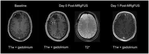Sample T1 Weighted Post Gadolinium Mri From Patient Five Obtained 30