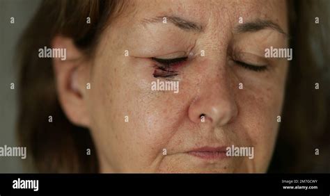 Basal Cell Carcinoma Scar Hi Res Stock Photography And Images Alamy