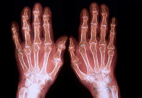 Undifferentiated Arthritis Identifying Candidates For Early Treatment