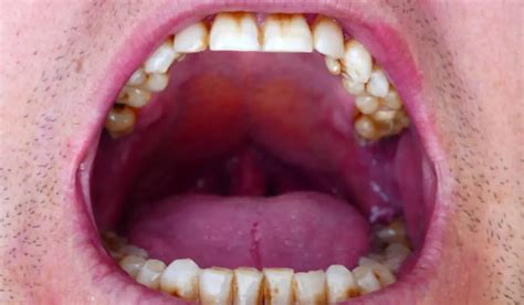 Why Is The Roof Of My Mouth Swollen When To See A Doctor