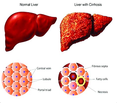 Comparative Diagrammatic Representation Of Normal Liver With Download Scientific Diagram