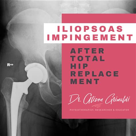 Iliopsoas Impingement After Total Hip Replacement Dr Alison Grimaldi Images And Photos Finder