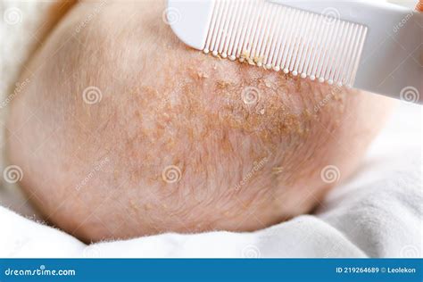 Removing Cradle Cap Of Seborrheic Dermatitis Treatment Stock Image