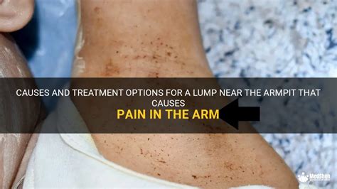 Causes And Treatment Options For A Lump Near The Armpit That Causes