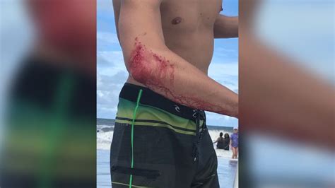 Shark Attacks Surfer Boogie Boarder Hurt In Separate Attacks Over The