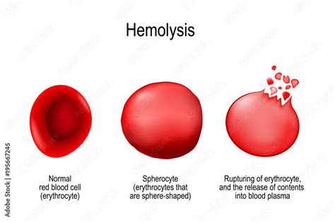 Hemolysis Normal Red Blood Cell Spherocyte And Rupturing Of
