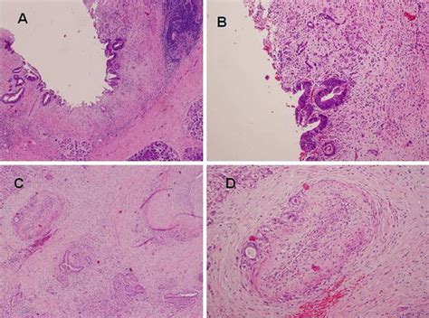 Pancreatic Adenocarcinoma Oncohema Key